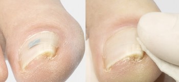 ingrown toenails